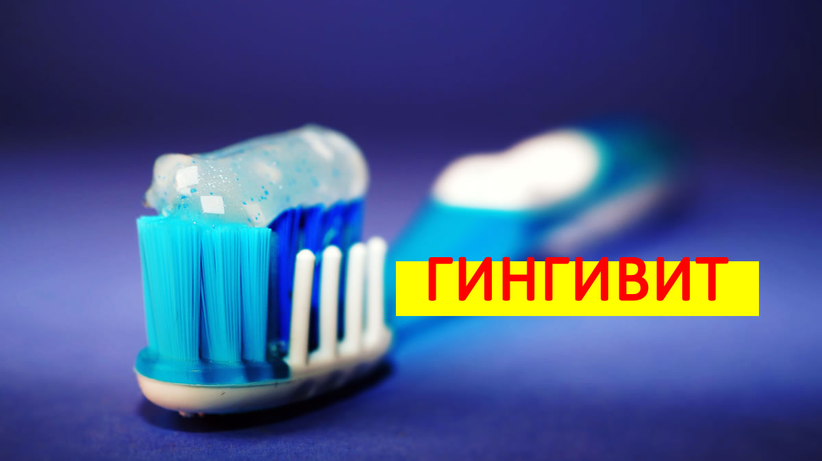 Гингивит! Вижте как да предотвратите появата му!