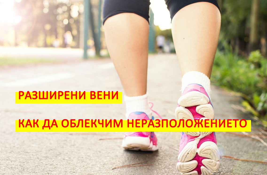 Разширени вени! Вижте как да облекчите състоянието си при появата им!