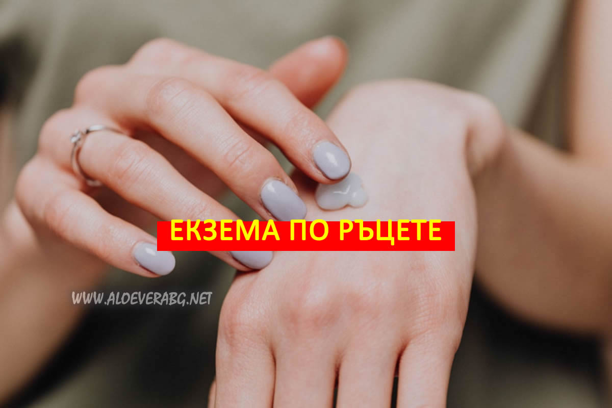 Екзема по ръцете - Вижте как да се предпазите!