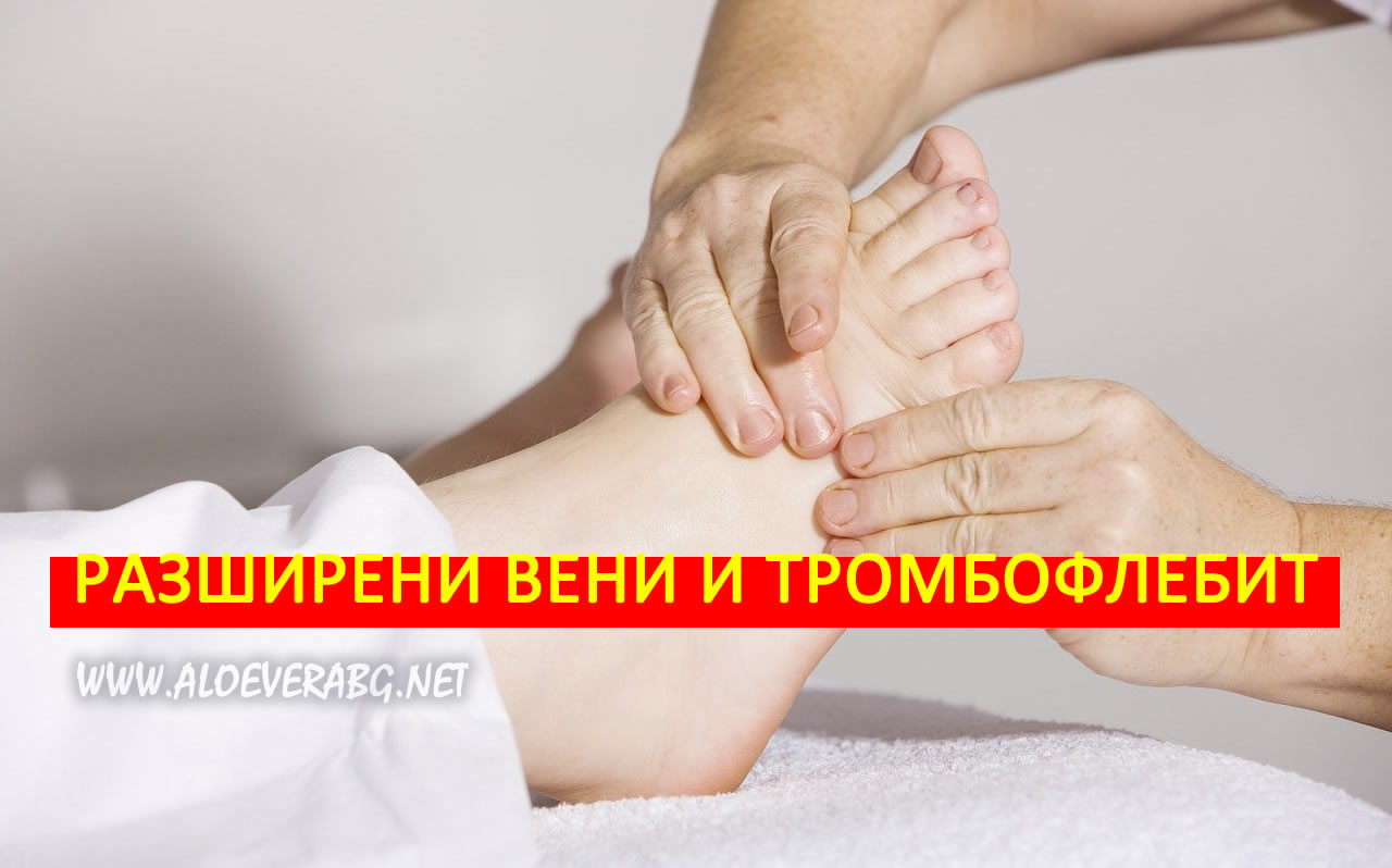 Разширени вени и Тромбофлебит - Симптоми и Лечение!