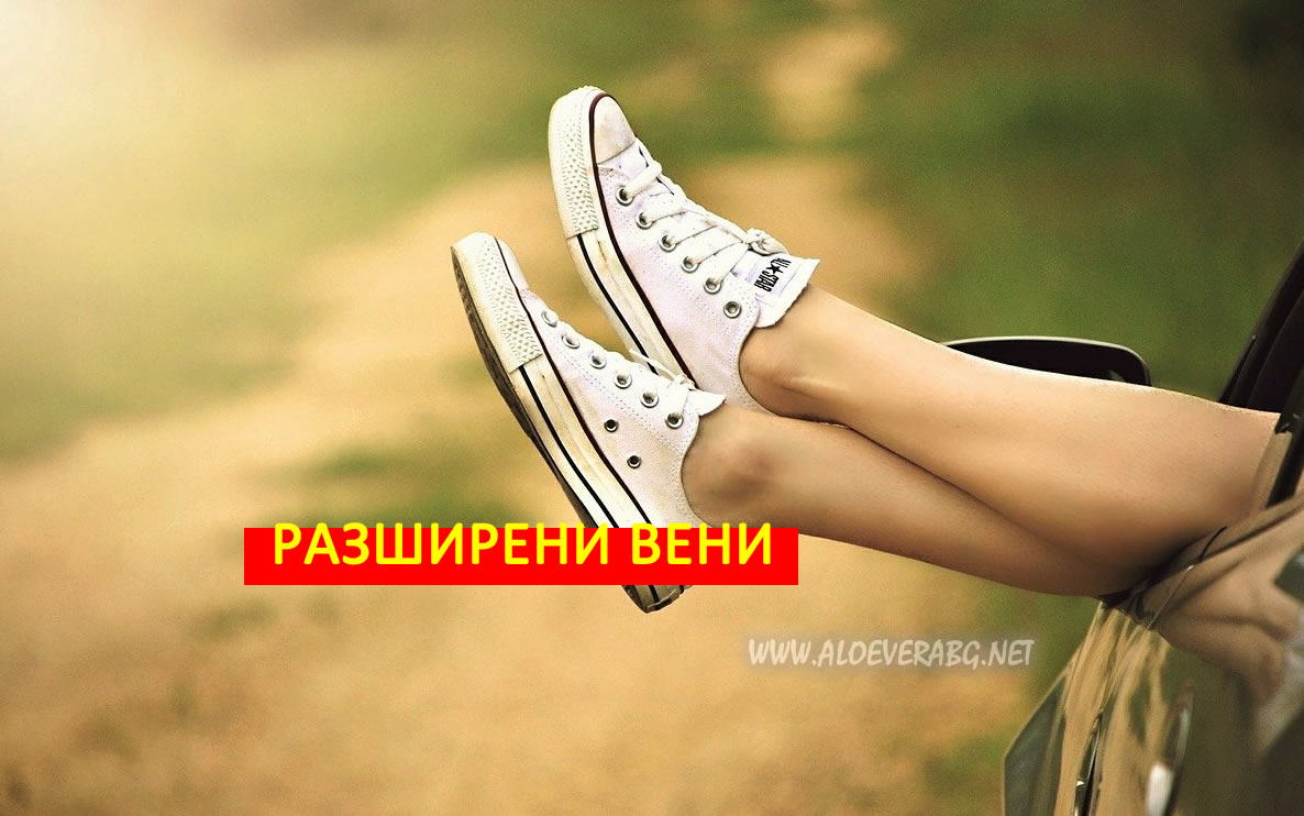Разширени вени - 5 Начина да облекчите симптомите!