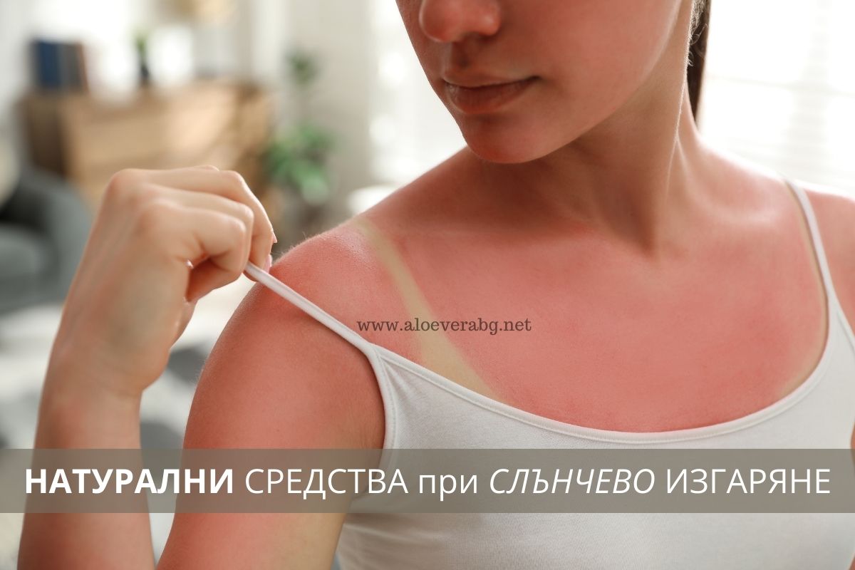 3 Натурални средства при Слънчево изгаряне!