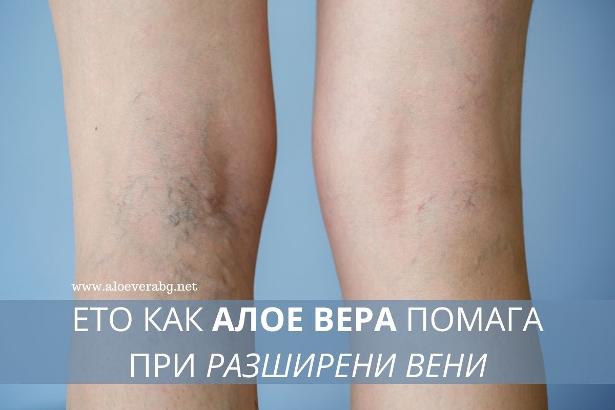 Ето как Алое вера Помага при Разширени Вени