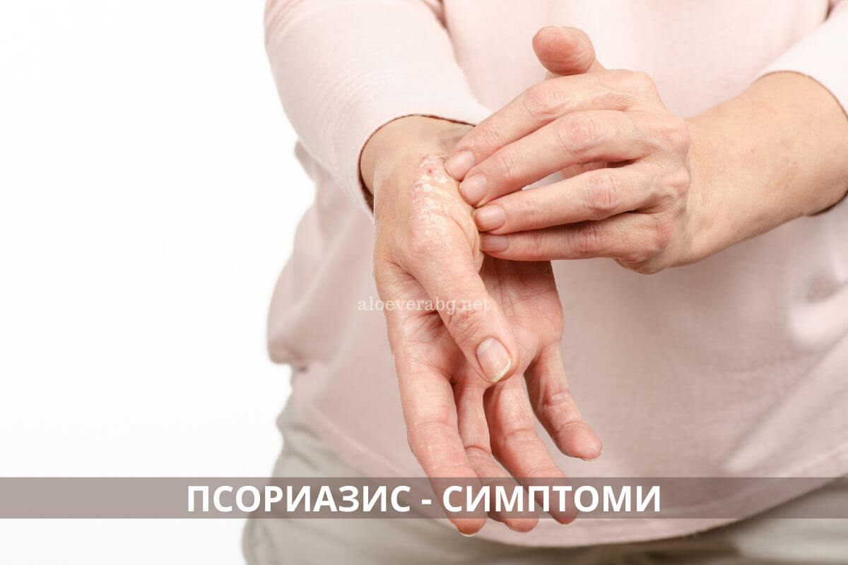 5 Симптома на псориазис